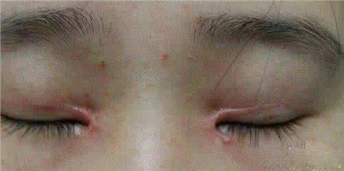 眼部整形术后疤痕照片