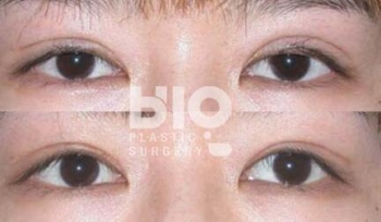 韩国BIO眼部修复整形前后效果