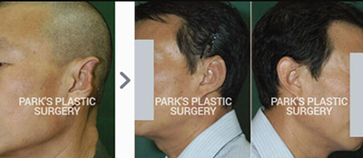 韩国BIO整形外科医院朴徹缺失耳整形照片