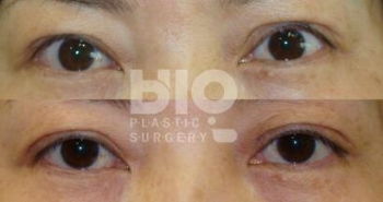 韩国BIO眼部修复前后照片