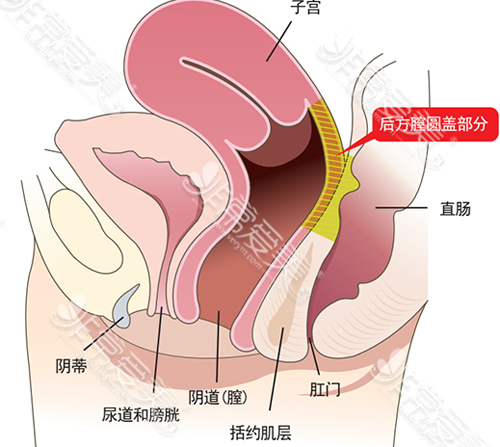 后方膣圆盖术手术部位