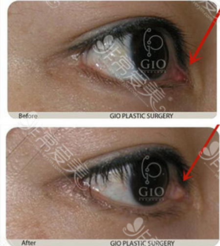 GIO医院内眼角疤痕修复案例