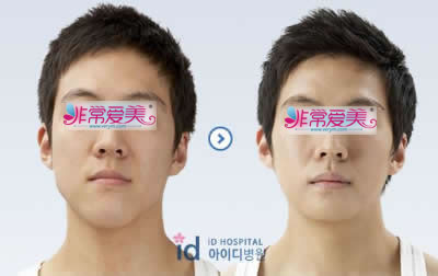 韩国ID医院面部下颚整形手术对比案例图