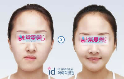韩国ID医院面部双鄂整形手术对比案例