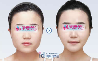 韩国ID整形外科下颌角整形手术对比案例