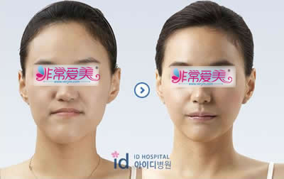 面部反颌整形手术对比案例