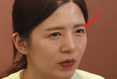 韩国kidari整形外科眼尾提升术前照片