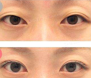 韩国kidari整形外科使用切开双眼皮进行眼尾提升效果图
