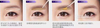 韩国kidari整形外科提眉术法详解图
