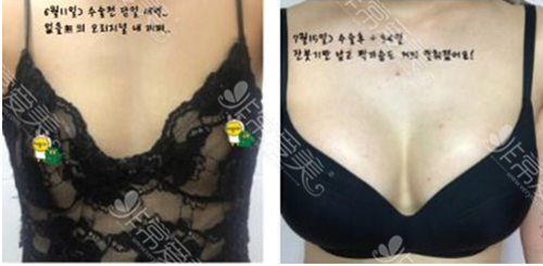 韩国PJS医院隆胸前后对比图