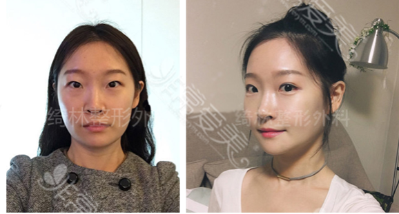 韩国绮林整形外科下颌角手术案例