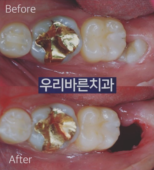 韩国woory牙科治疗案例