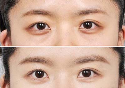 韩国ID整形外科眼部整形照片
