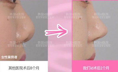 韩国ID整形外科鼻部整形案例图