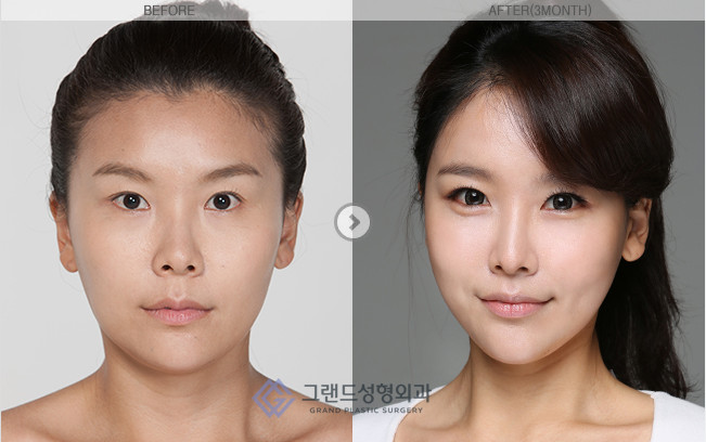 例韩国高兰得整形外科面部轮廓对比案