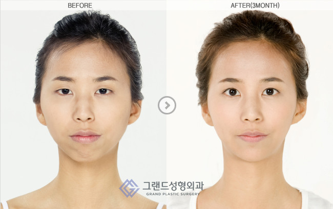 韩国高兰得整形外科凸嘴手术前后对比案例图