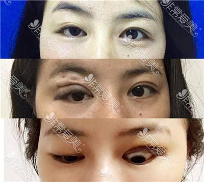 足不出户体验韩国名医的高超修复技术，你关注的眼鼻轮廓!