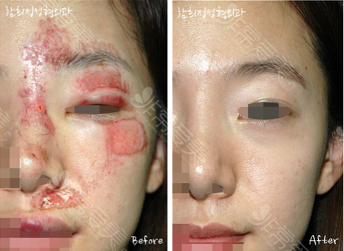 曝光韩国疤痕修复案例！深度解析韩国修复疤痕比国内强吗?
