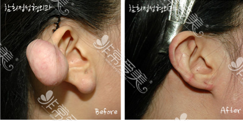 耳后疤痕疙瘩治疗前后