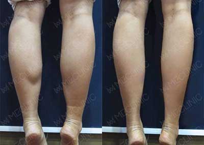 韩国美柯丽妮ME皮肤科瘦小腿整形案例图