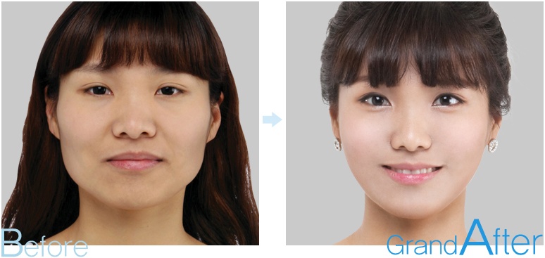 韩国高兰得整形外科面部轮廓手术前后照片