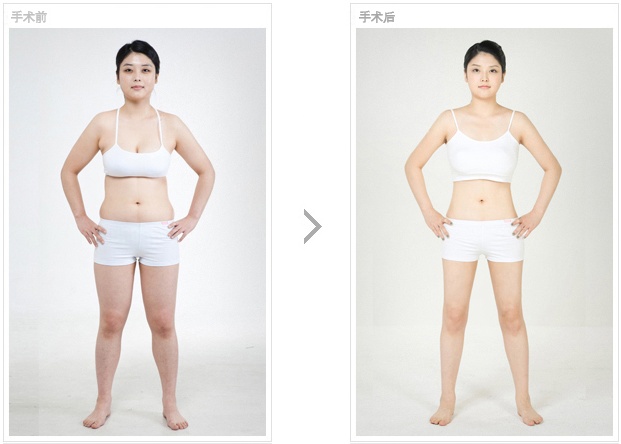 韩国高兰得全身吸脂手术前后对比照片