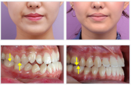 韩国纽约微笑牙科牙齿矫正案例