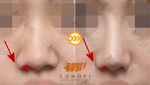 韩国高诺鼻鼻翼缩小手术对比图