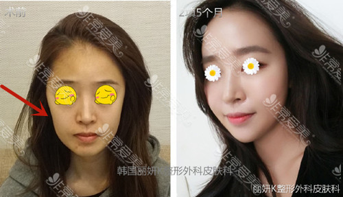韩国丽妍k整形外科面部填充照片