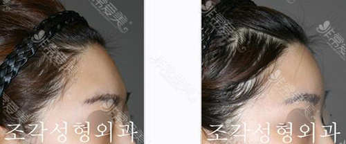 韩国脸部填充好吗？有几种方法？手术部位有哪些？全解析!
