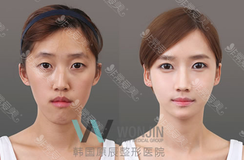 韩国脸部填充好吗？有几种方法？手术部位有哪些？全解析!