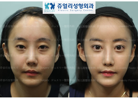 韩国珠儿丽医院面部整形手术前后对比照片