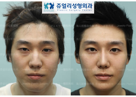 韩国珠儿丽整形外科男士面部手术案例图