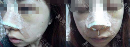韩国朱诺整形鼻修复即刻照片