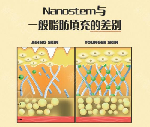 韩国德莱茵Nanostem脂肪填充与一般脂肪填充的区别