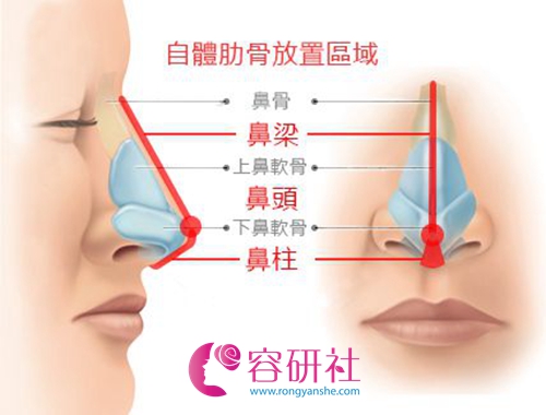 肋软骨隆鼻放置区域示意图