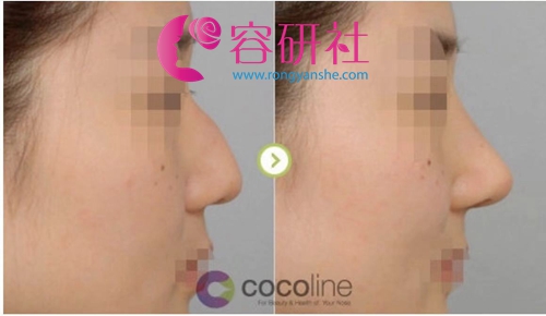 韩国cocoline整形医院高难度鼻修复案例