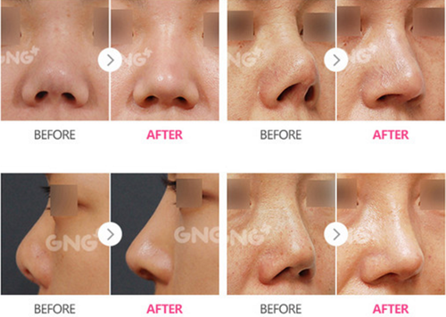 韩国GNG整形外科高难度鼻修复案例