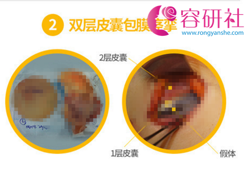 韩国麦恩整形医院皮囊取出法治疗包膜挛缩