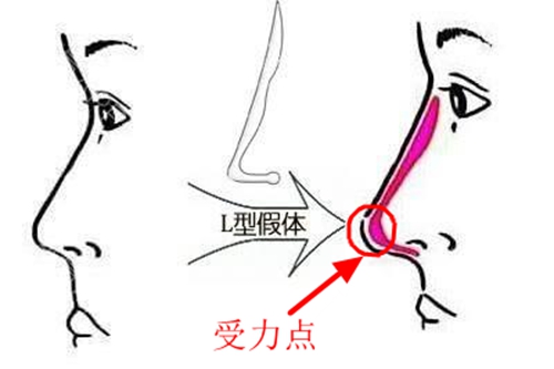 L型硅胶假体隆鼻