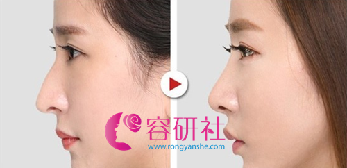 韩国欧佩拉整形外科鼻修复案例