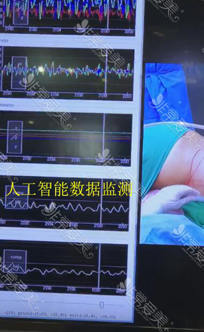 韩国365mc人工智能吸脂手术实况