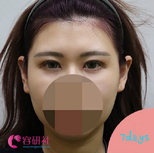 韩国POP整形外科医院双眼皮术后7天照片
