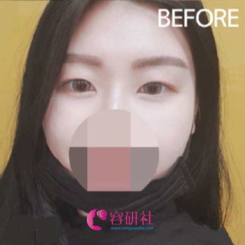 韩国POP整形外科医院双眼皮术前照