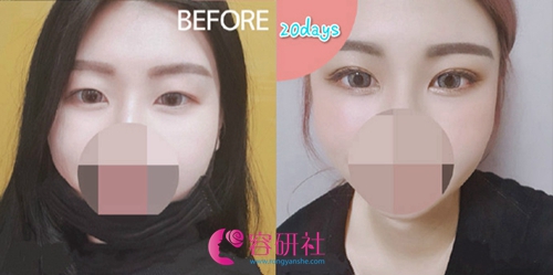 韩国POP整形外科医院双眼皮术前术后对比照