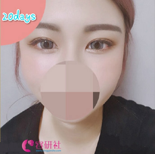 韩国POP整形外科医院双眼皮术后20天照片