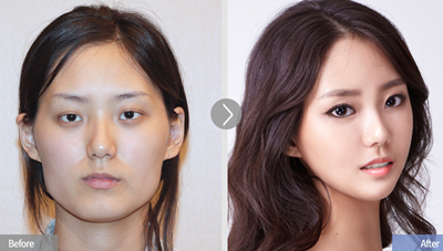 韩国faceline整形外科李真秀院长面部轮廓效果图