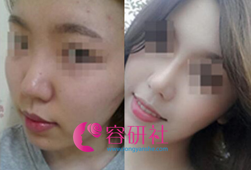 韩国will整形外科鼻部修复案例