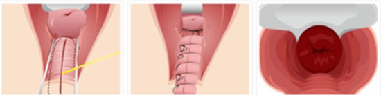 后方膣圆盖术手术方法示意图