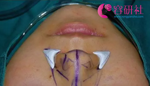 鼻基底假体的植入位置
